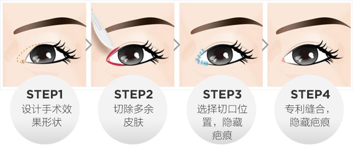 开眼角