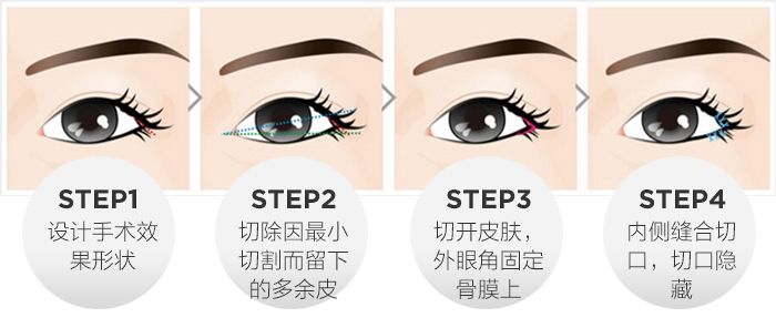 开外眼角